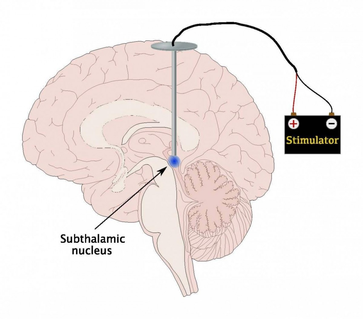 Estimulação Cerebral Remota: Um novo Tratamento para a Doença de Parkinson?